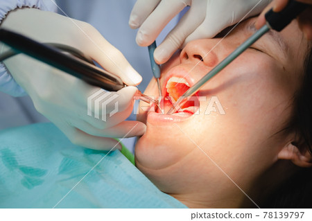 Woman is undergoing dental treatment and specialist is doing check up and curing teeth patient. Woman is undergoing dental treatment and specialist is doing check up and curing teeth patient. 78139797