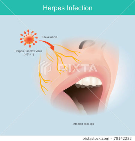 Herpes Infection. Illustration human facial nerve skin for use explain herpes simplex virus lip infection.. Herpes Infection. Illustration human facial nerve skin for use explain herpes simplex virus lip infection.. 78142222