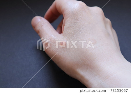 皮炎 皮膚問題 皮膚粗糙 濕疹 蟲咬 手部濕疹 家庭主婦濕疹 家庭主婦濕疹 7 皮炎 皮膚問題 皮膚粗糙 濕疹 蟲咬 手部濕疹 家庭主婦濕疹 家庭主婦濕疹 7 78155067