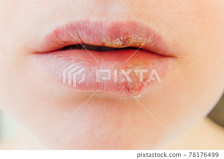 Close up of girl lips affected by herpes. Treatment of herpes infection and virus. Part of young woman face, lips with herpes affected. Beauty dermatology concept. 78176499