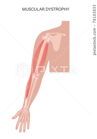 Muscular dystrophy of arm 78183833