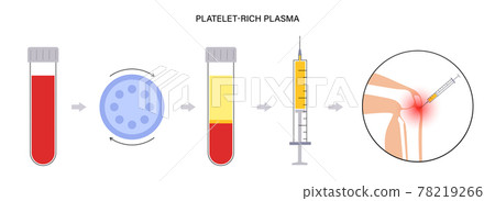 Platelet rich plasma concept 78219266