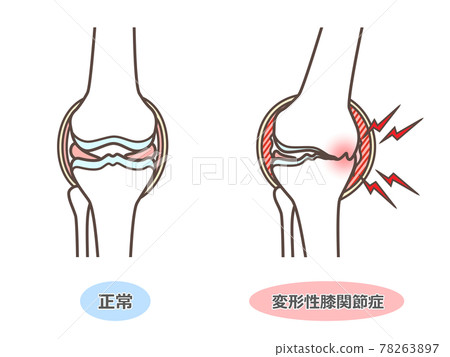 Illustration of knee osteoarthritis 78263897