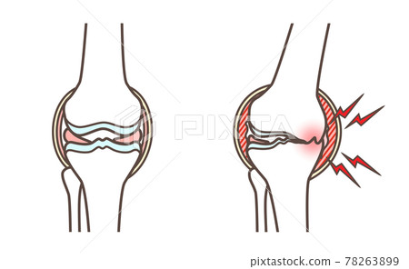 Illustration of knee osteoarthritis 78263899