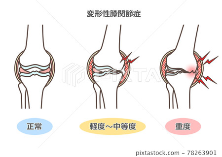 膝關節骨關節炎的插圖 78263901