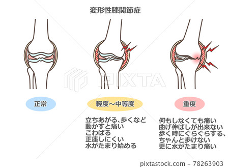 Illustration of knee osteoarthritis 78263903