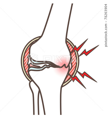 Illustration of knee osteoarthritis - Stock Illustration [78263904] - PIXTA