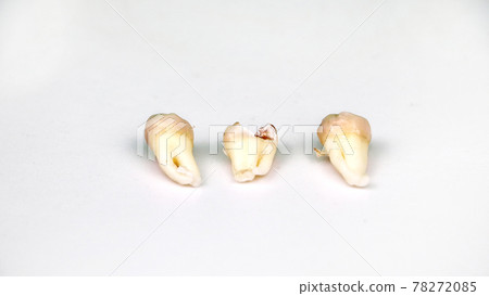 Removed wisdom tooth on white Removed wisdom tooth on white 78272085