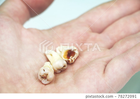 Removed wisdom tooth on white Removed wisdom tooth on white 78272091