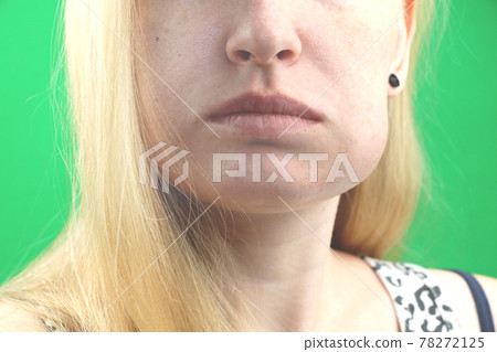 Teeth Problem. Gumboil, flux and swelling of the cheek. Closeup Of Beautiful Sad Girl Suffering From Strong Tooth Pain. Attractive Female Feeling Painful Toothache, Dental Health And Care Concept 78272125