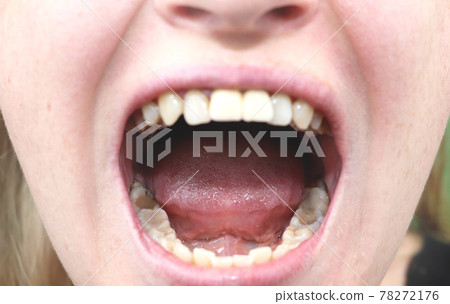 Close-up of the holes from the extracted teeth. Removal of wisdom teeth and eights. Rear chewing. Carious. Operation 78272176