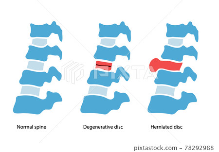 intervertebral hernia concept intervertebral hernia concept 78292988