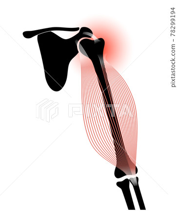 Biceps tear trauma 78299194