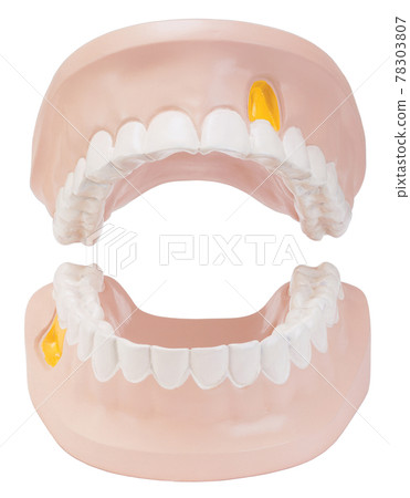 Dentures with bright teeth and mouth open Dentures with bright teeth and mouth open 78303807