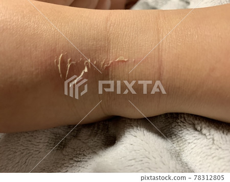 赤腳磨損 赤腳磨損 78312805