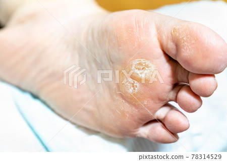 腳底的玉米照片 78314529