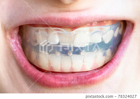orthodontic trainer for correction of teeth bite 78324027