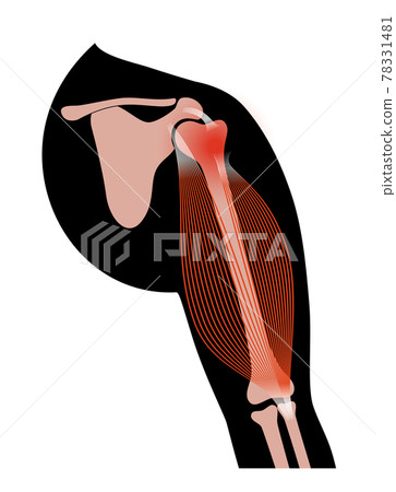 Biceps tear trauma 78331481