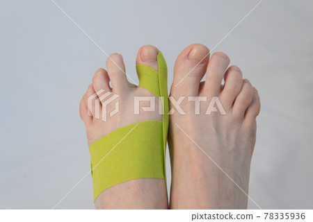Feet close-up, top view. There is a tap on the big toe. Correction of finger deformity. Hallux valgus. Innovative medicine Feet close-up, top view. There is a tap on the big toe. Correction of finger deformity. Hallux valgus. Innovative medicine 78335936