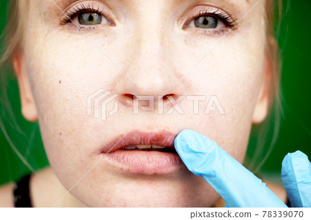 herpes on the lips, part of a woman's face with finger on lips with herpes, beauty concept herpes on the lips, part of a woman's face with finger on lips with herpes, beauty concept 78339070