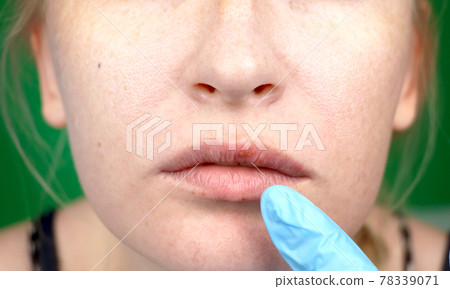 herpes on the lips, part of a woman's face with finger on lips with herpes, beauty concept 78339071