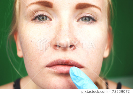 herpes on the lips, part of a woman's face with finger on lips with herpes, beauty concept 78339072
