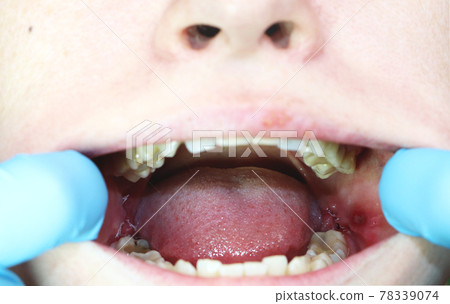 Operation removal of wisdom teeth - eights. Stitching, postoperative period 78339074