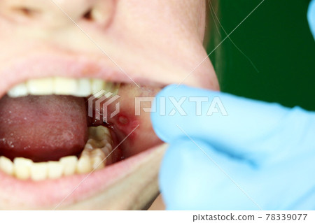 Painful ulcer and stomatitis on the mucous cheek of a girl. After the operation to remove the wisdom teeth. Stitches and postoperative period Painful ulcer and stomatitis on the mucous cheek of a girl. After the operation to remove the wisdom teeth. Stitches and postoperative period 78339077