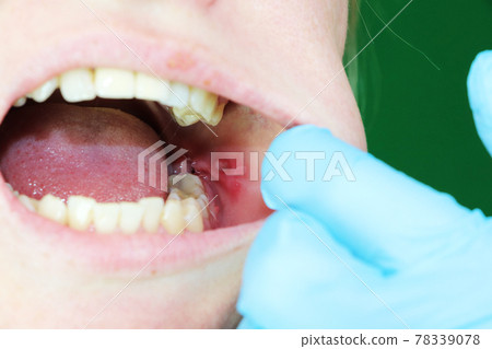 Painful ulcer and stomatitis on the mucous cheek of a girl. After the operation to remove the wisdom teeth. Stitches and postoperative period 78339078