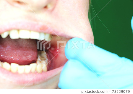 Painful ulcer and stomatitis on the mucous cheek of a girl. After the operation to remove the wisdom teeth. Stitches and postoperative period Painful ulcer and stomatitis on the mucous cheek of a girl. After the operation to remove the wisdom teeth. Stitches and postoperative period 78339079