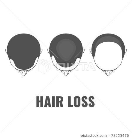 Male pattern baldness three steps infographics template 78355476
