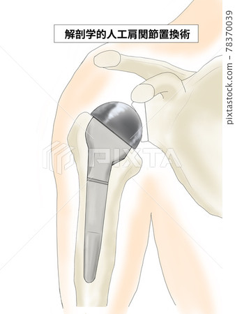 解剖人工肩關節全置換術 解剖人工肩關節全置換術 78370039