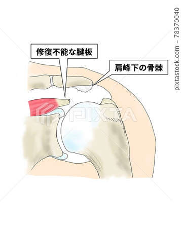 Extensive rotator cuff tear 78370040
