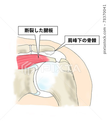 Rotator cuff tear Rotator cuff tear 78370041