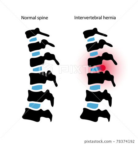 intervertebral hernia concept 78374192