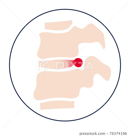 intervertebral hernia concept intervertebral hernia concept 78374196