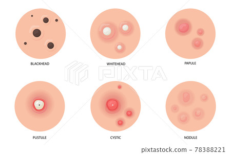Different types of acne flat illustration set for web design Different types of acne flat illustration set for web design 78388221