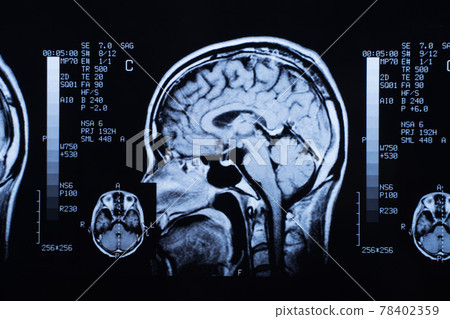 頭部 MRI 圖像 78402359