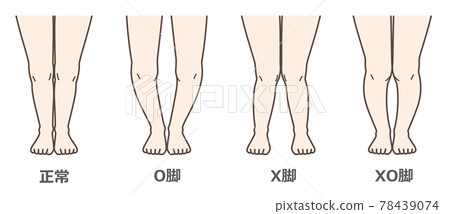 膝關節骨關節炎圖示 78439074