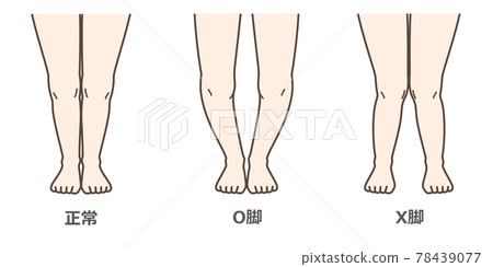 膝關節骨關節炎圖示 膝關節骨關節炎圖示 78439077