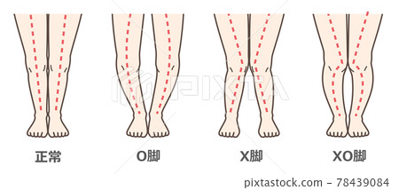 膝關節骨關節炎圖示 78439084