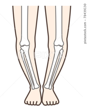 O-legged legs, illustrations for explaining diseases of the legs and knees 78439130