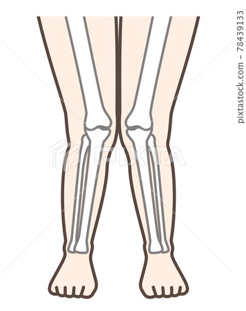 解釋 X 腿和膝蓋疾病的插圖 解釋 X 腿和膝蓋疾病的插圖 78439133