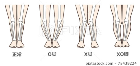 Knee osteoarthritis illustrated Knee osteoarthritis illustrated 78439224