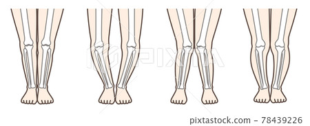 Knee osteoarthritis illustrated 78439226