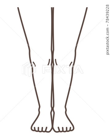 解釋正常腳和膝蓋疾病的插圖 78439228