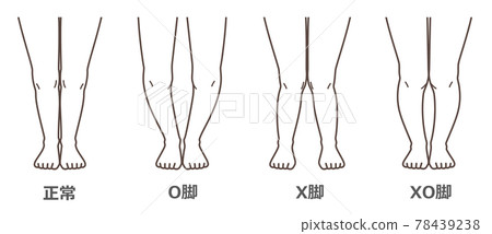 膝關節骨關節炎圖示 78439238