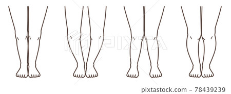 Knee osteoarthritis illustrated 78439239