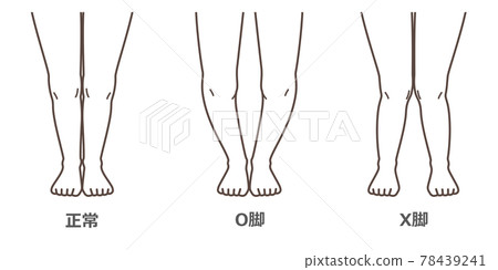 Knee osteoarthritis illustrated 78439241