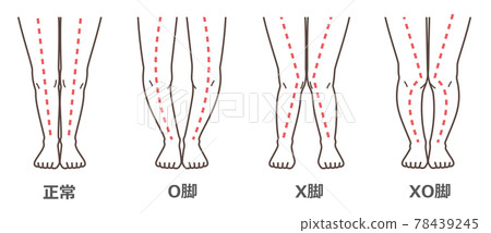 膝關節骨關節炎圖示 78439245